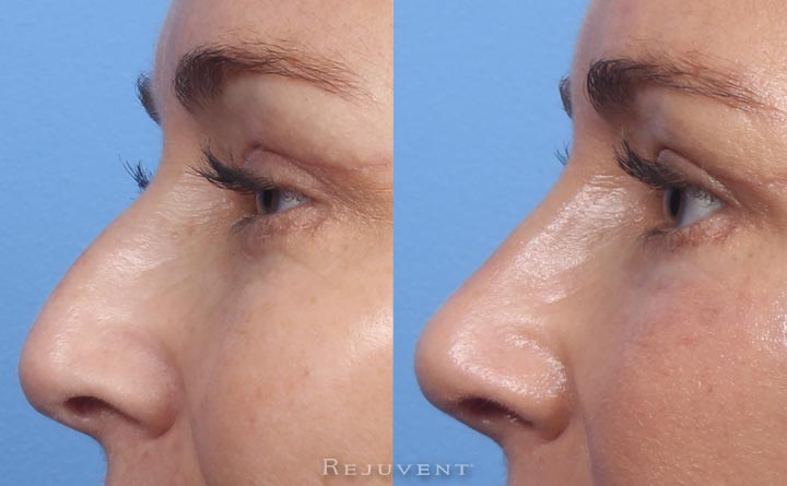 Natural looking Liquid Rhinoplasty Results
