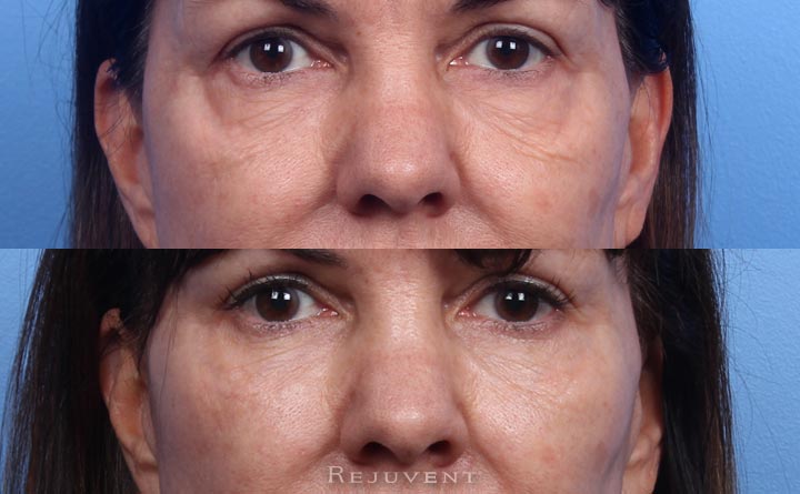 Under Eye Area rejuvenated with Filler in Scottsdale, AZ