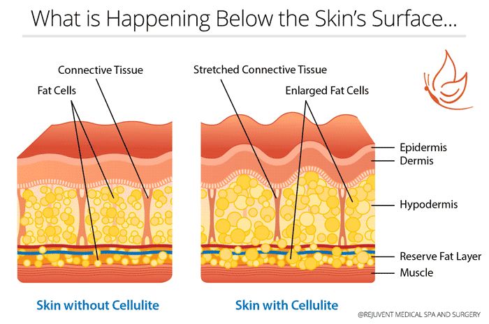 What is Cellulite and What to do About it... • Rejuvent Medical Spa  Scottsdale