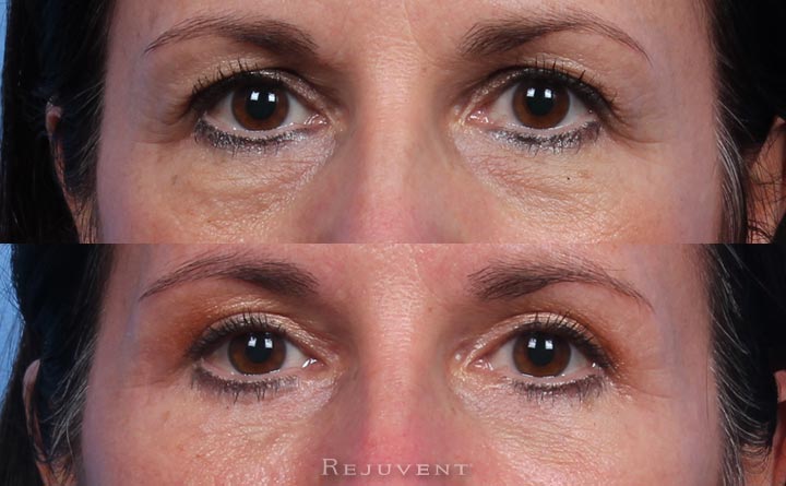Before and After Blepharoplasty at Rejuvent