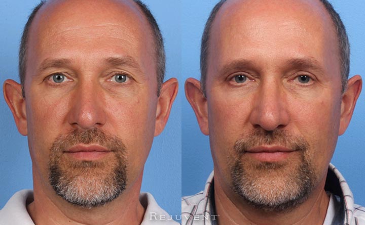 Lower and Upper Blepharoplasty Male Patient Before and After image