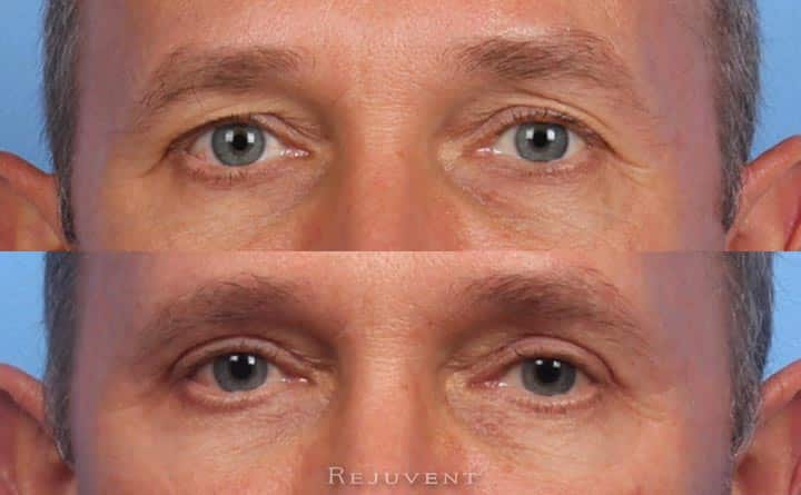 Male Patient Closeup Up Lower and Upper Eyelid surgery