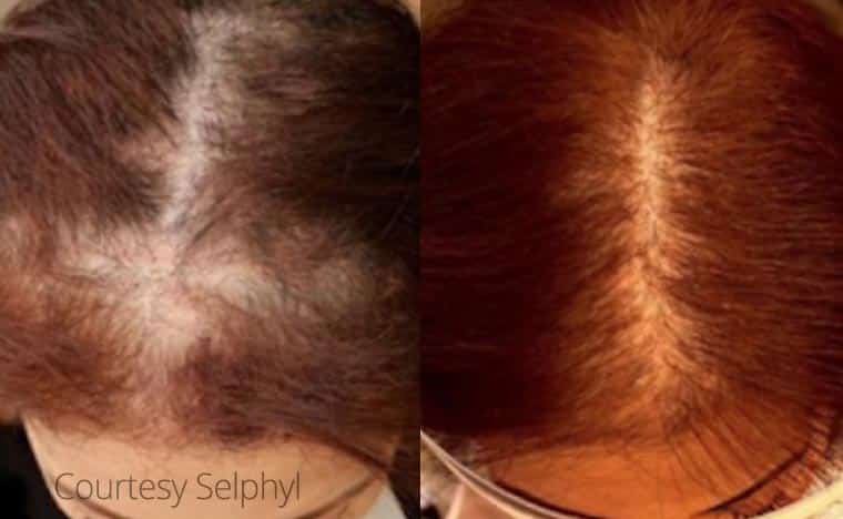Hair Loss in Women