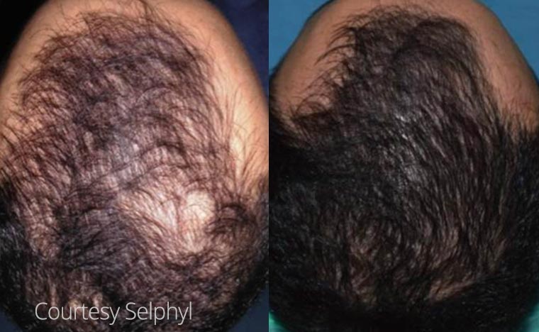 Before and after image of PRP hair loss patient