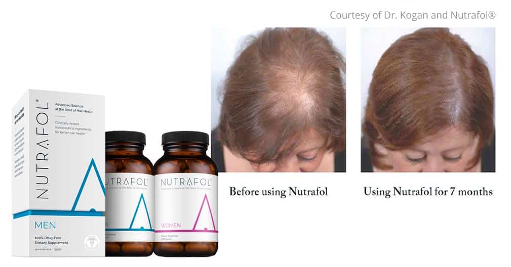 Nutrafol box and bottles