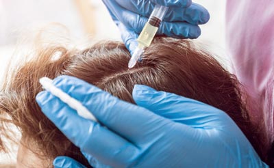 PRP injection on the scalp