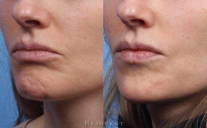 Restylane Lyft Chin Augmentation