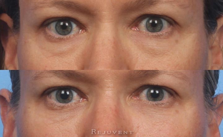 Beautiful before after under eye filler injection