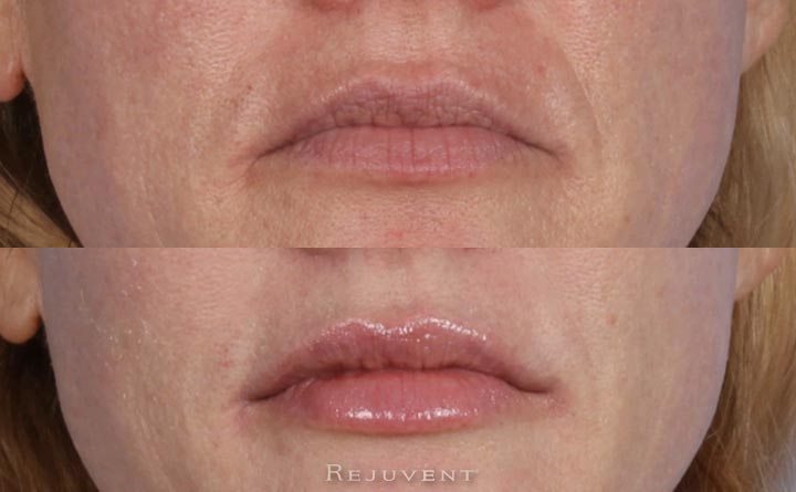 Lip  Filler Injections