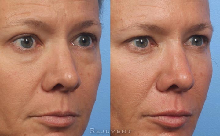 Side view under eye filler injections