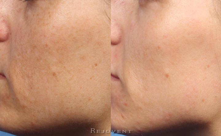IPL clear skin results with less pigmentation