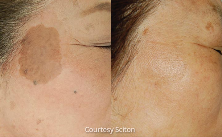 BBL dark spots can be gone
