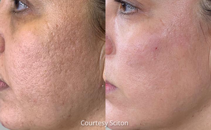 HALO acne scars results before and after