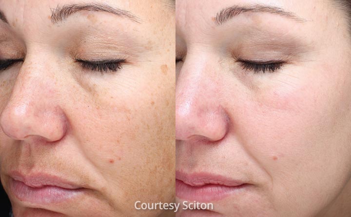 HALO Clear skin rejuvenations results
