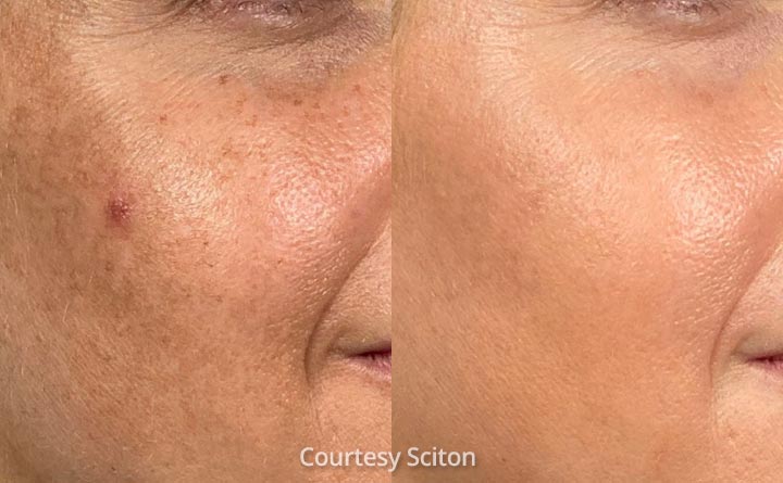 Halo before and after results