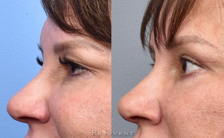 Upper and lower Blepharoplasty eyelid results side view