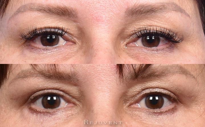 Upper and lower blepharoplasty beautiful results