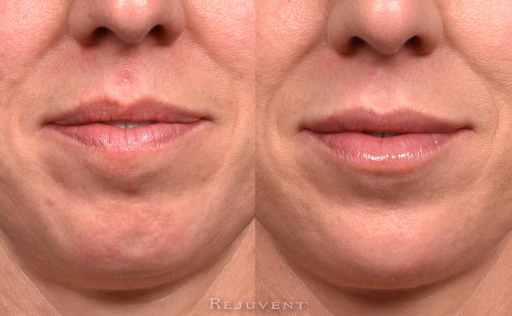 Front view Chin filler injections