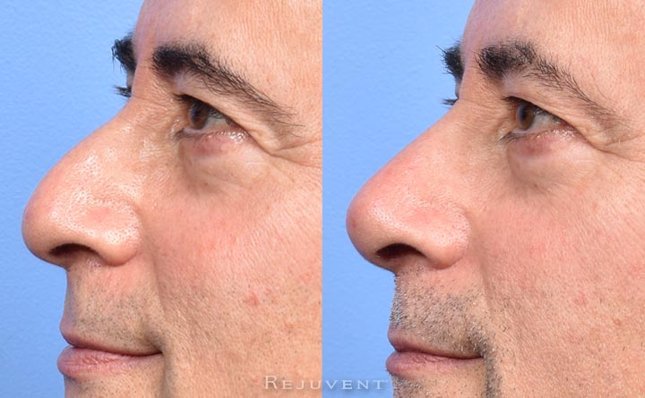 Liquid  Rhinoplasty before and after improvement
