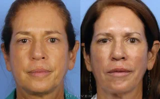 FIllers and Wrinkle Relaxers