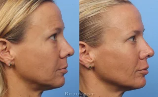 Beautiful Liquid facelift Results Side view